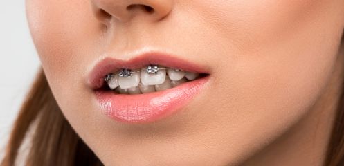 Overbite, openbite or crossbite